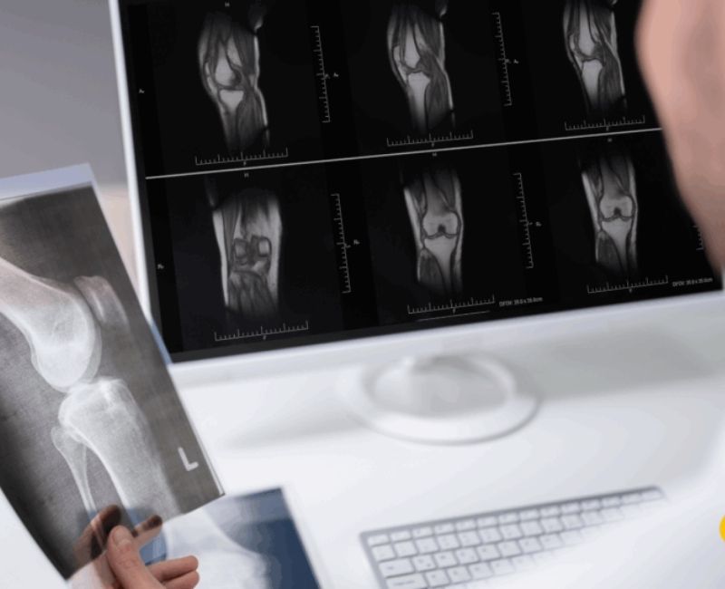 Lekarz analizuje wyniki MRI w chorobie zwyrodnieniowej kolana