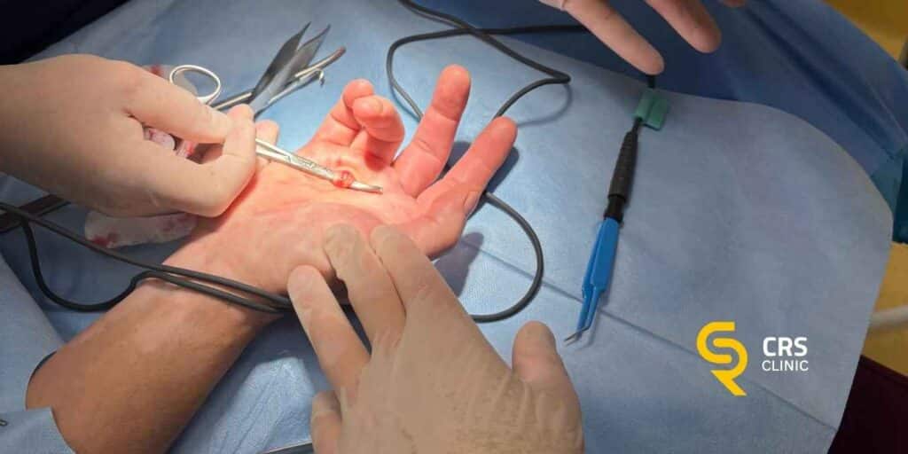 Lekarz ortopeda przeprowadza operację palca zatrzaskującego w CRS Clinic Warszawa