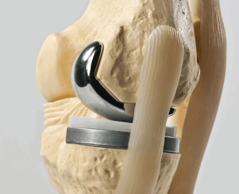 Model endoprotezy kolana