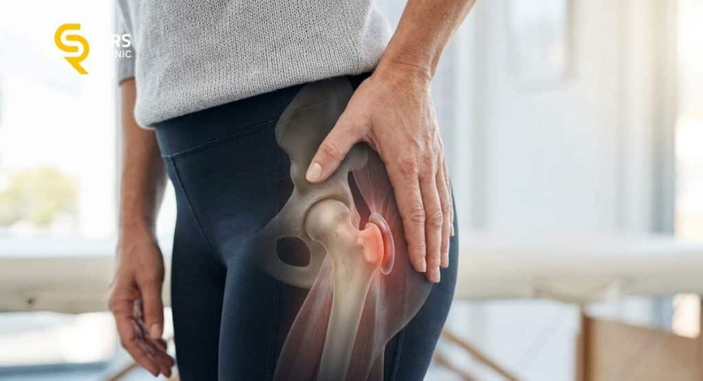 Pacjentka w gabinecie ortopedycznym z wyraźnie zaznaczonym anatomicznie miejscem występowania bólu biodra od zapalenia kaletki