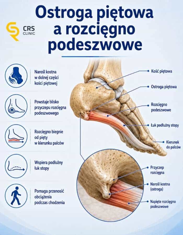 Infografika przedstawiająca model i budowę rozwijającej się ostrogi piętowej (grafika poglądowa)