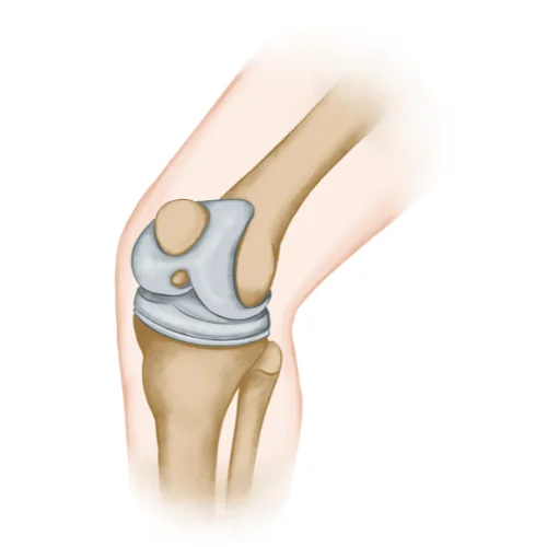 endoproteza stawu kolanowego