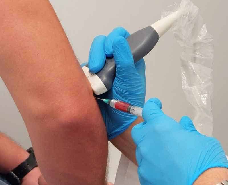 Lekarz ortopeda wykonuje iniekcję PRP (osocza bogatopłytkowego) pod kontrolą USG
