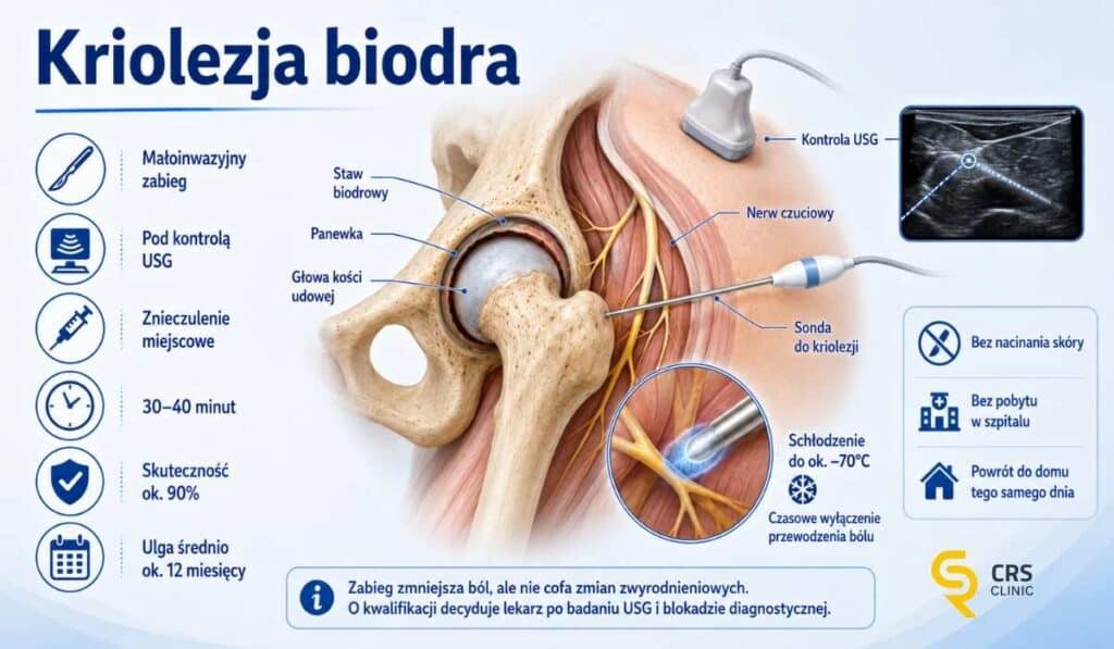 Infografika przedstawiająca anatomię stawu biodrowego i miejsce przeprowadzania zabiegu kriolezji