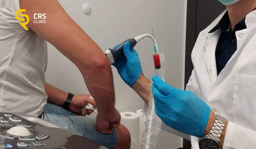 Lekarz ortopeda przeprowadza iniekcję regeneracyjną PRP (osocze bogatopłytkowe) na łokieć tenisisty w CRS Clinic Warszawa