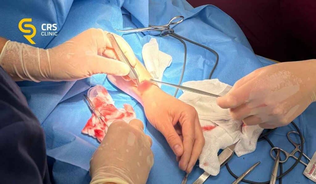 Lekarz ortopeda przeprowadza operację cieśni nadgarstka w CRS Clinic Warszawa