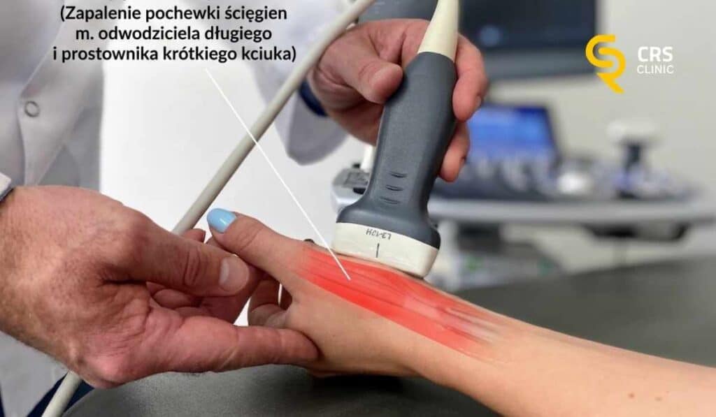 Lekarz ortopeda wykonuje badanie USG u pacjentki z chorobą de Quervaina w CRS Clinic Warszawa