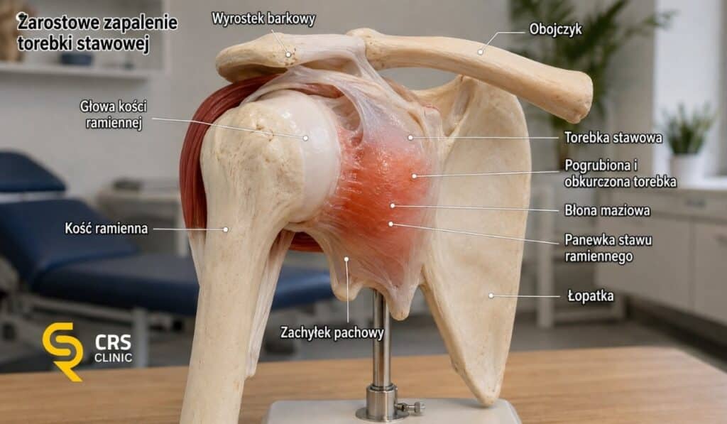 Model anatomiczny barku zamrożonego z pogrubioną i obkurczoną torebką stawu ramiennego oraz zmniejszonym zachyłkiem pachowym.