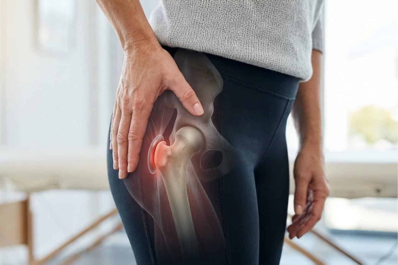 Pacjentka z bólem biodra z anatomicznie zaznaczonym modelem przedstawiającym zapalenie kaletki krętarza większego