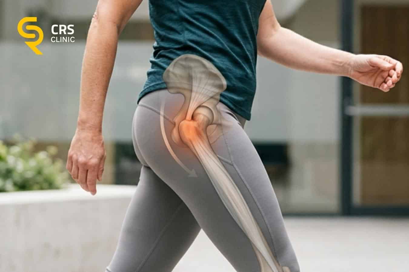 Pacjentka z wyraźnie zaznaczonym anatomicznie miejscem występowania trzaskającego biodra